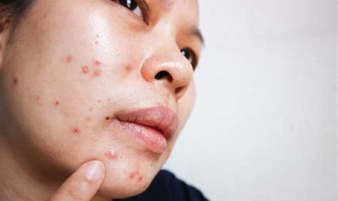 cara mengatasi jerawat hormon